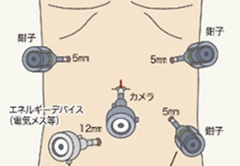 図2　直腸の場合の位置