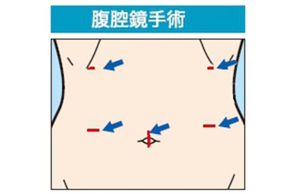 図3　胃の場合の位置