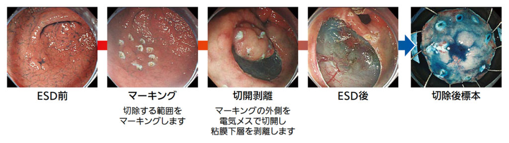 図3 ESDによる内視鏡切除