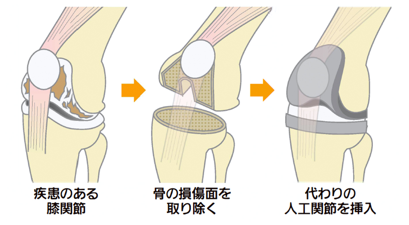 骨折 リハビリ 膝蓋骨