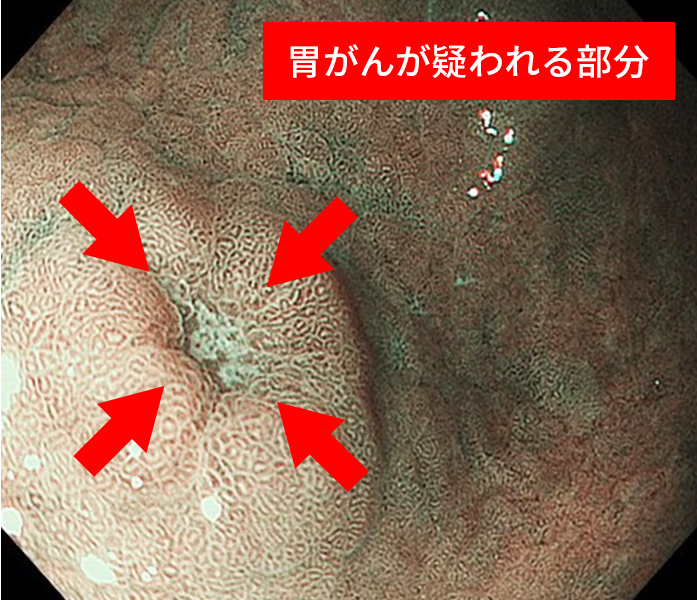 【NBI観察】通常光の観察よりも病気によるわずかな変化もわかりやすくなります