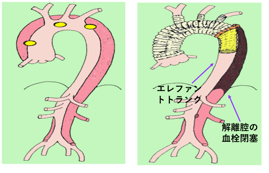 図5　急性A型解雄に対する上行弓部全置換術