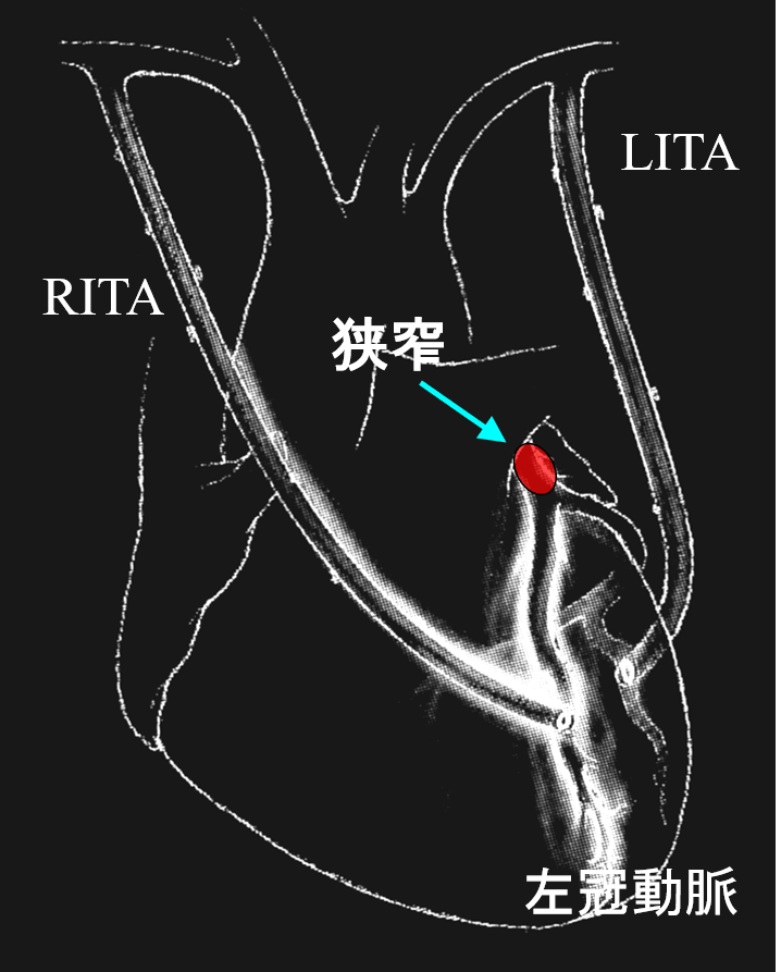 図1　両側内胸動脈(LITA,RITA)を用いた冠動脈バイパス術