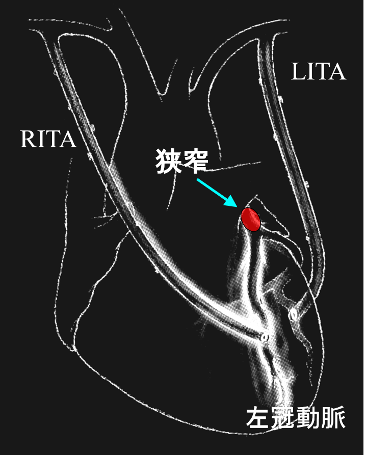 図1 両側内胸動脈(LITA,RITA)を用いた冠動脈バイパス術