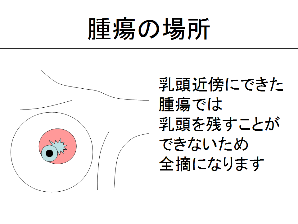 腫瘍の場所