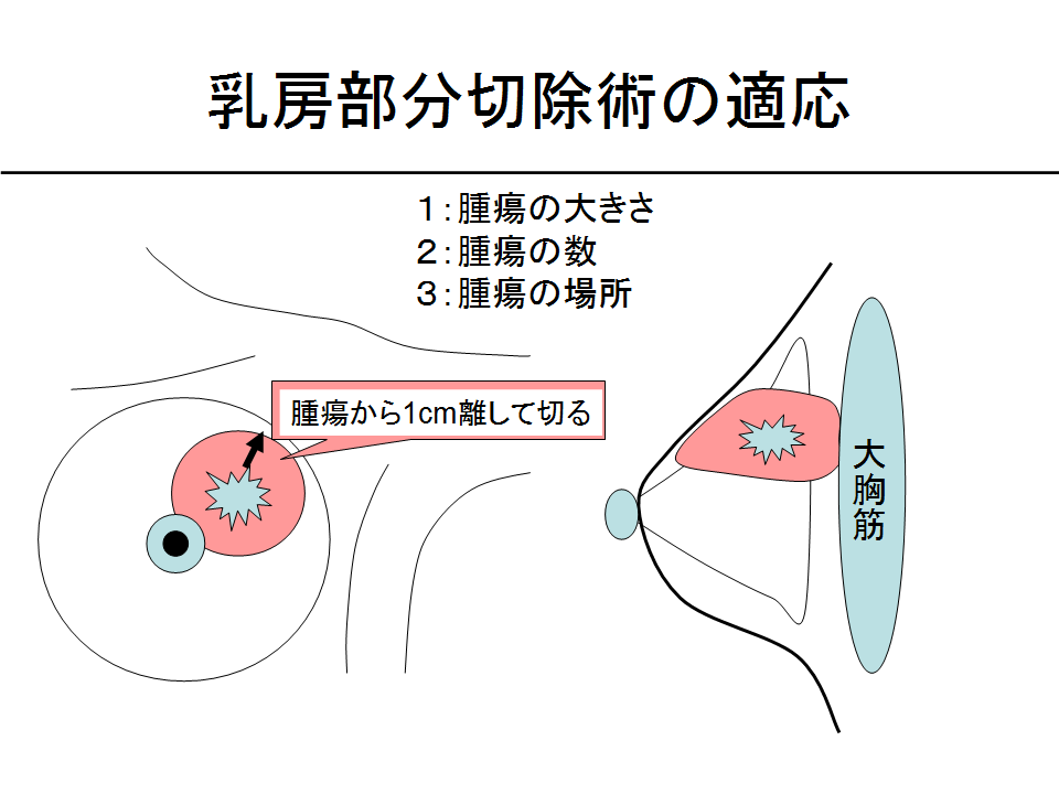 乳房切除術