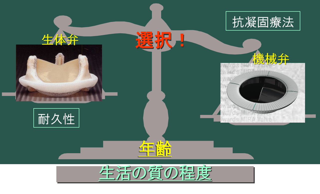 図2 弁置換時の人工弁の選択