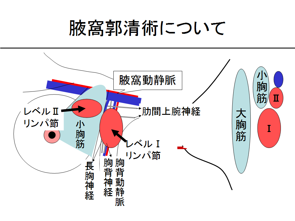 腋窩郭清術について