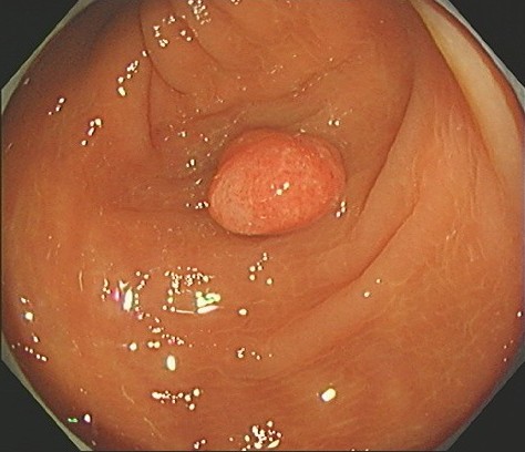 通常光による内視鏡画像。中央にあるのが大腸ポリープです。