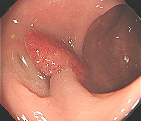 1.通常光(赤い部分が大腸ポリープです)