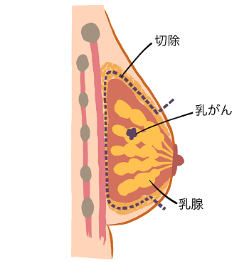 図1　（乳がん手術前）
