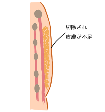 （乳がん手術後）