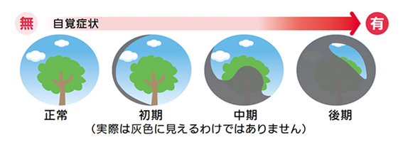 図1　視野の欠け方のイメージ