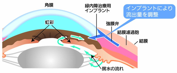 緑内障治療用インプラント挿入手術