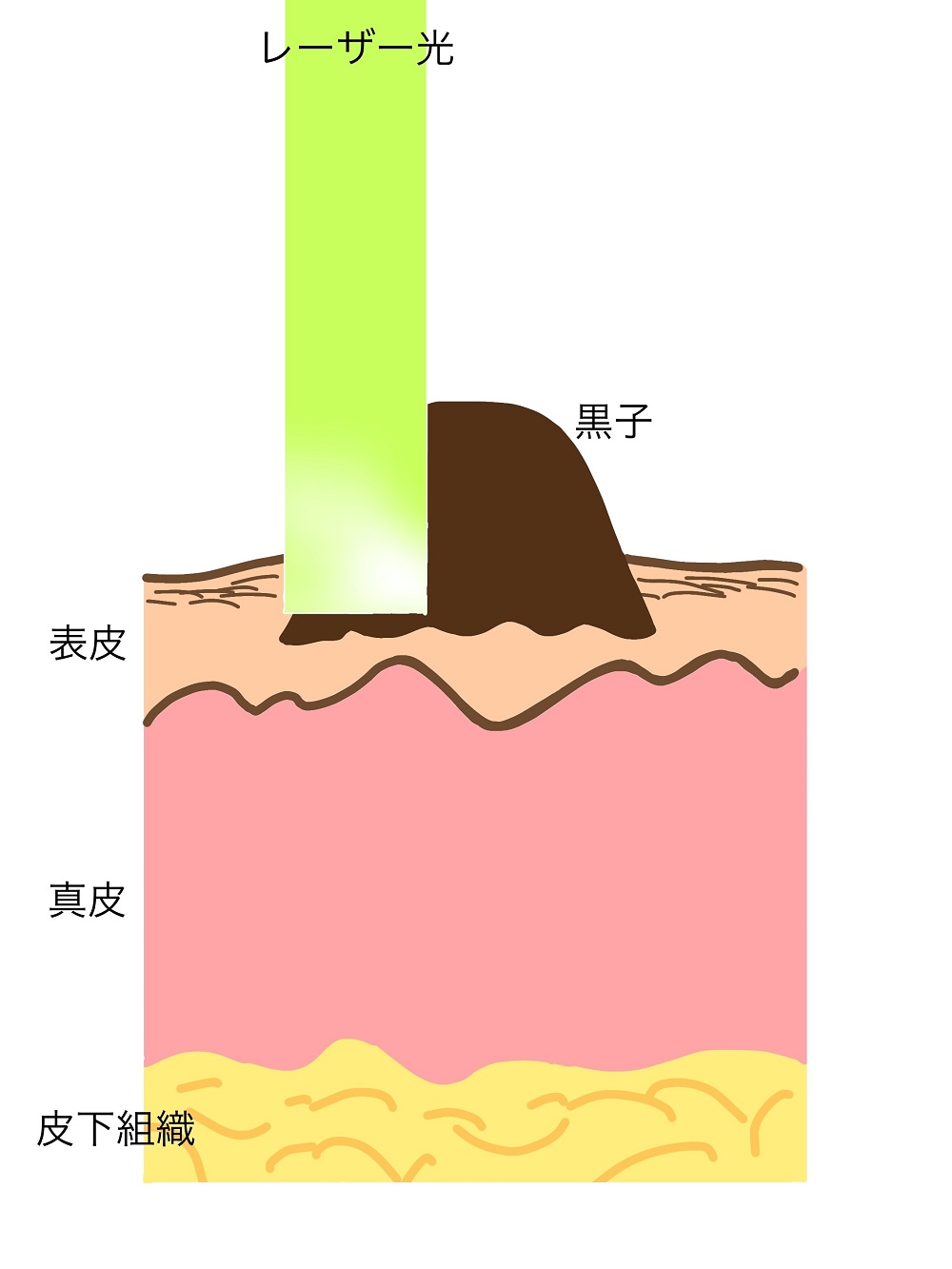 炭酸ガスレーザー照射前