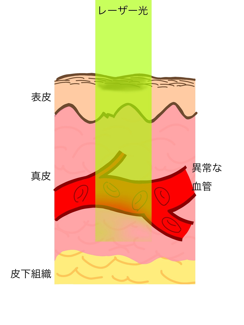 色素レーザー（Vbeam）照射前