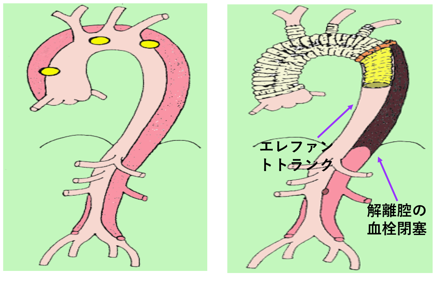 図5　急性A型解離に対する上行弓部全置換術