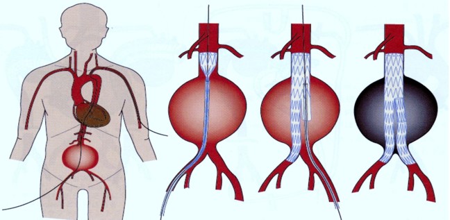図4　腹部大動脈瘤に対するステントグラフト内挿術