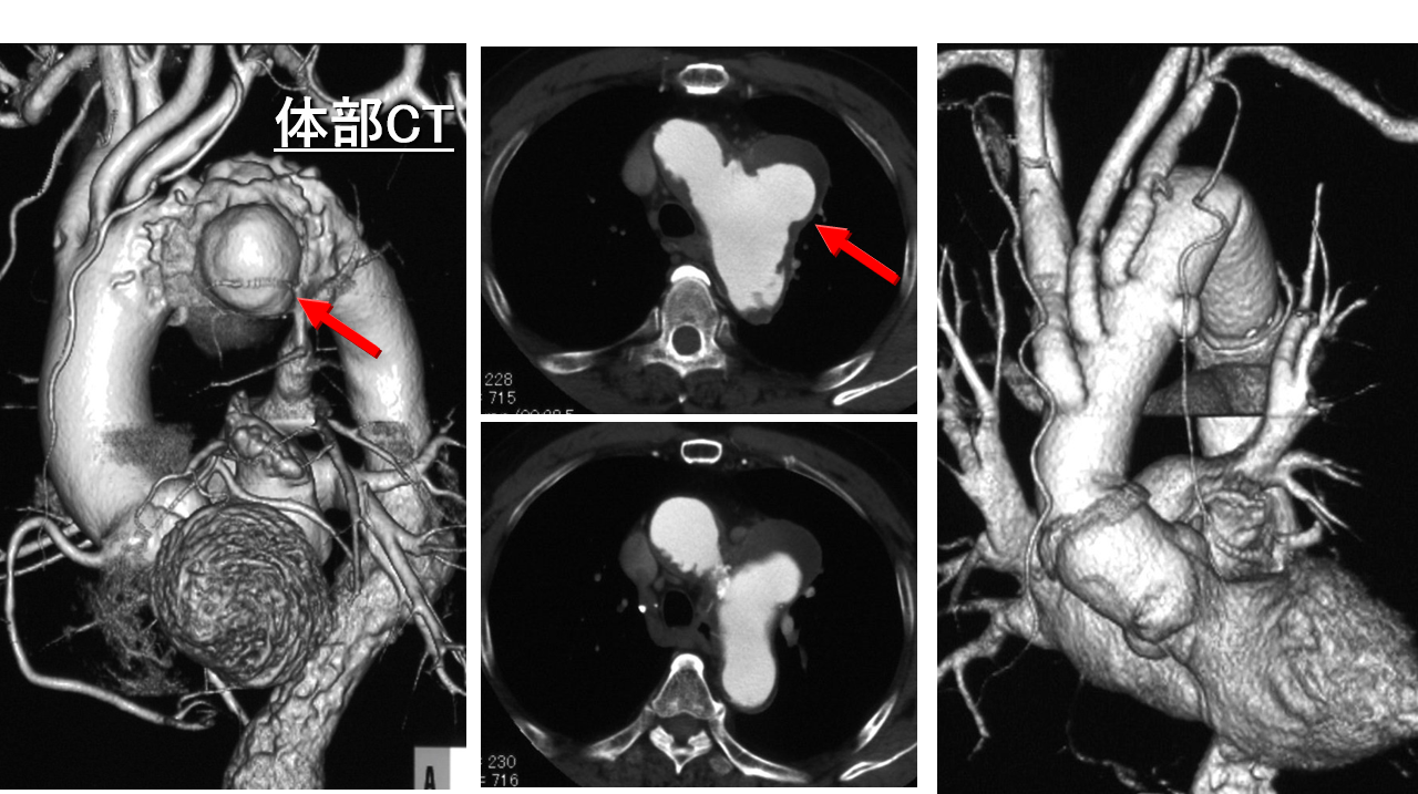 図3　遠位弓部大動脈瘤に対する弓部全置換術（73歳男性）