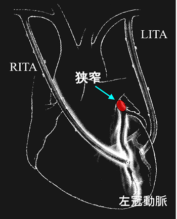 図1　両側内胸動脈(LITA,RITA)を用いた冠動脈バイパス術
