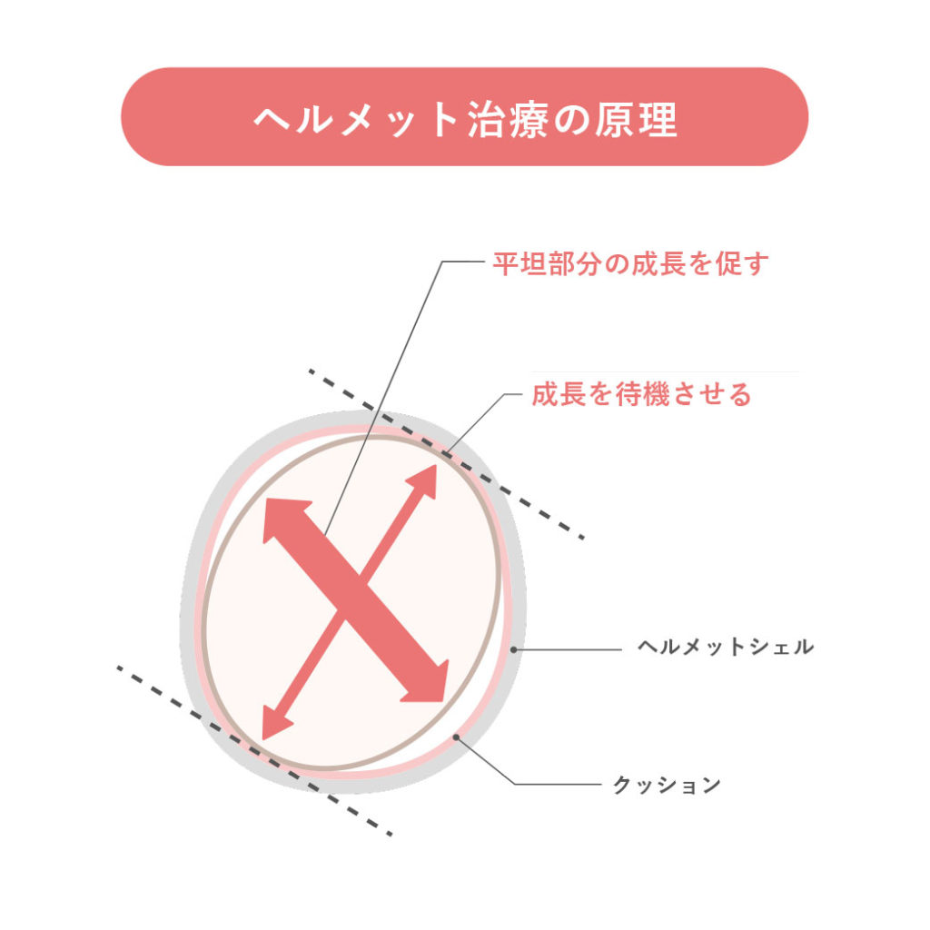 ヘルメット治療の原理
